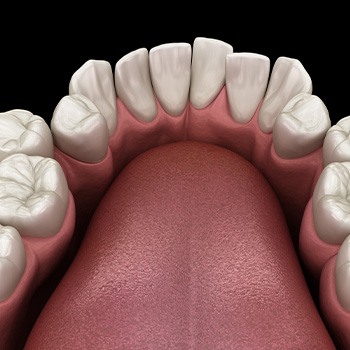 Illustration of crowded teeth