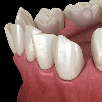 Illustration of gapped teeth