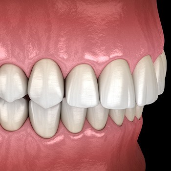Illustration of an overbite