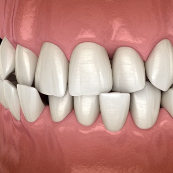 Illustration of a crossbite