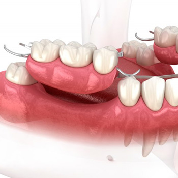 Illustration of partial denture