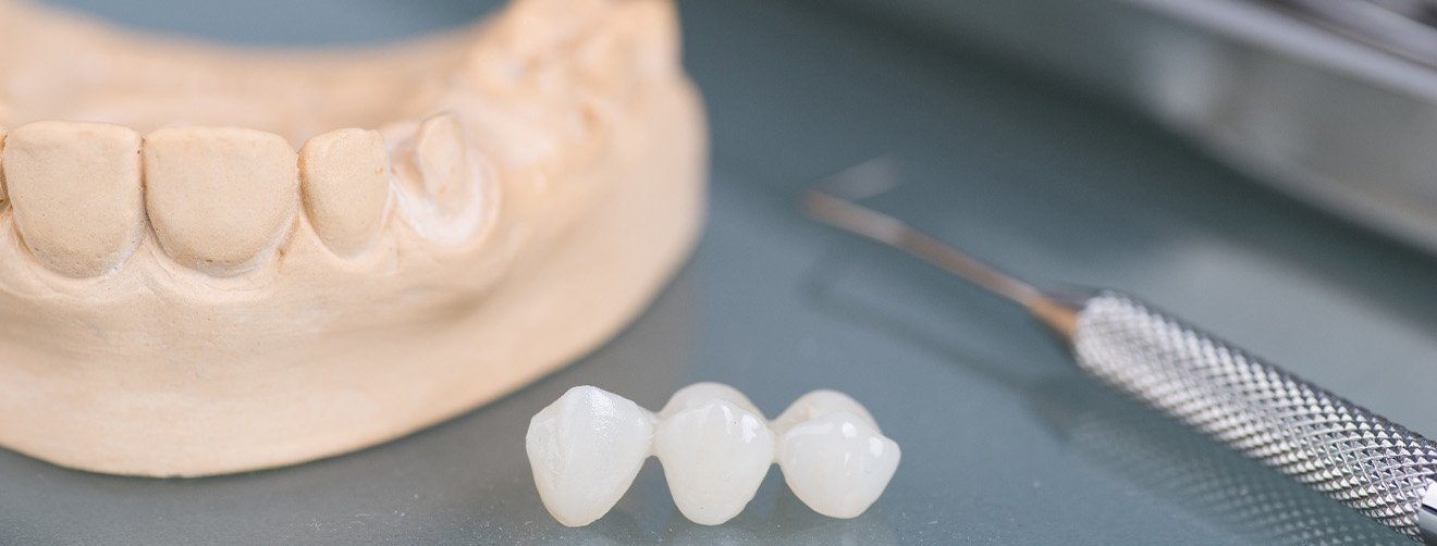 Dental bridge in front of model teeth next to dental instrument on reflective surface.