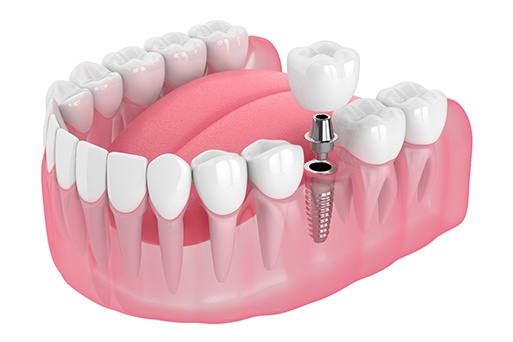 Illustration of a single dental implant