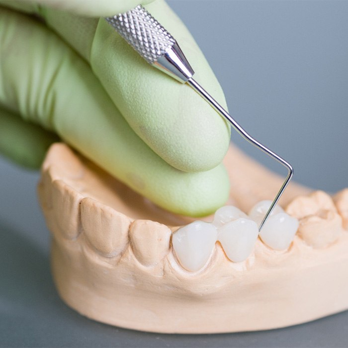 Green-gloved hand poking dental bridge on model teeth.