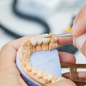 Hands customizing traditional dental bridge on model teeth.