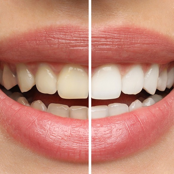 Closeup of patient's teeth before and after teeth whitening