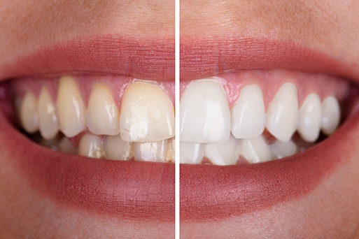 Options for making teeth whitening more affordable include flexible financing and special offers from Athens Dental Associates