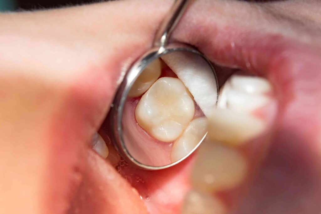 Closeup of a dental filling