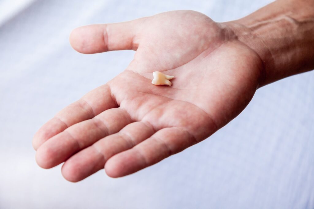 Lost tooth resting in the palm of a hand