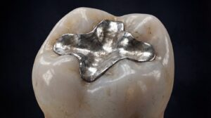 Close-up of tooth with metal filling.
